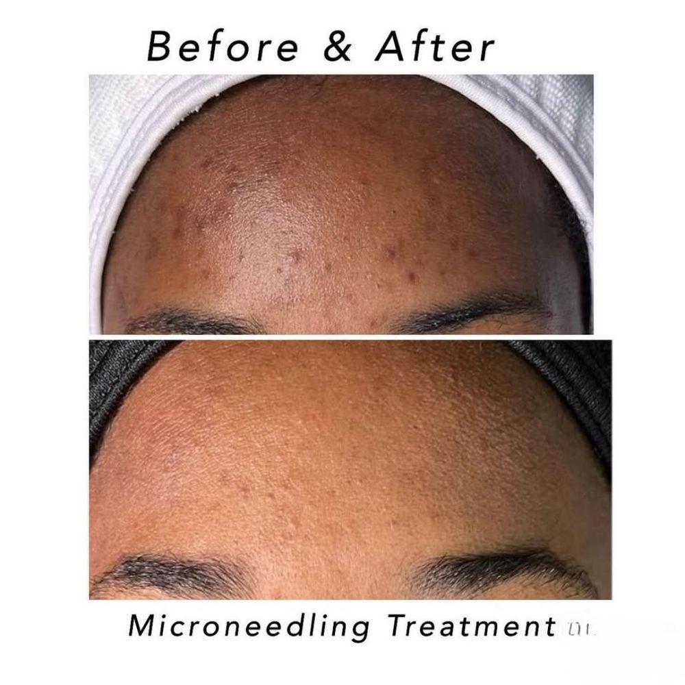 Sponge Microneedle Cream- Niacinamide Radiance Boost